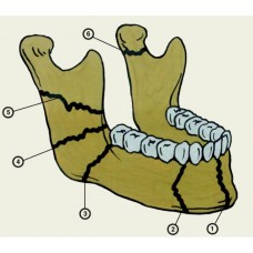 Виды переломов нижней челюсти из пластмассы (8 моделей)